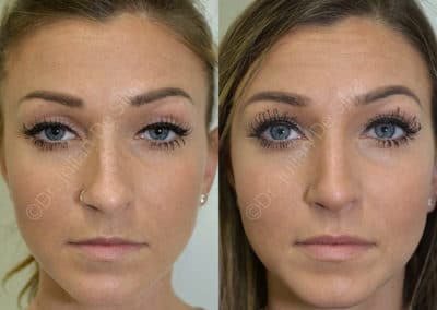 Rhinoplasty in London Before & After Results