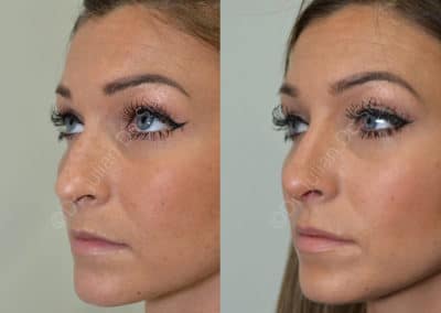 Rhinoplasty in London Before & After Results