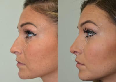 Rhinoplasty in London Before & After Results