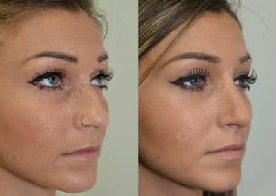 Rhinoplasty in London Before & After Results