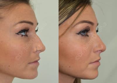 Rhinoplasty in London Before & After Results