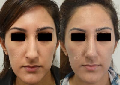 Rhinoplasty in London Before & After Results