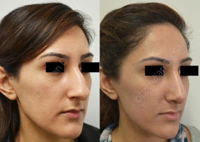 Rhinoplasty in London Before & After Results