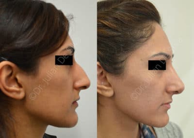 Rhinoplasty in London Before & After Results