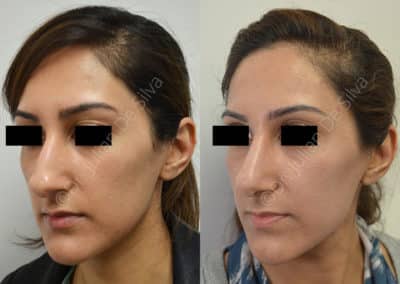 Rhinoplasty in London Before & After Results