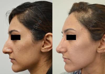 Rhinoplasty in London Before & After Results