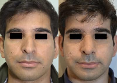 Rhinoplasty in London Before & After Results