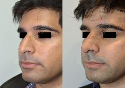 Rhinoplasty in London Before & After Results