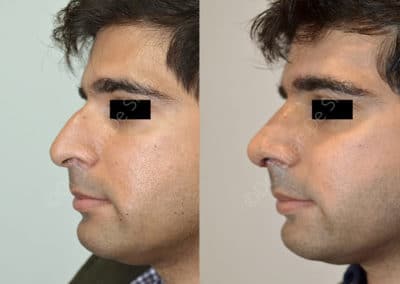 Rhinoplasty in London Before & After Results