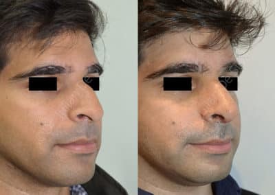 Rhinoplasty in London Before & After Results