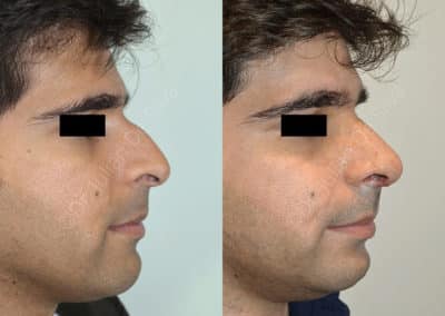 Rhinoplasty in London Before & After Results