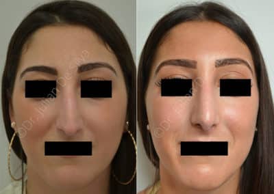 Rhinoplasty in London Before & After Results