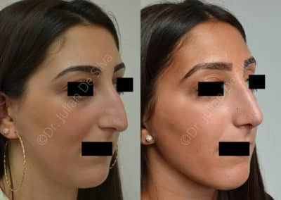 Rhinoplasty in London Before & After Results