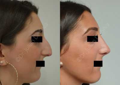 Rhinoplasty in London Before & After Results