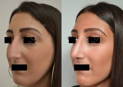 Rhinoplasty in London Before & After Results