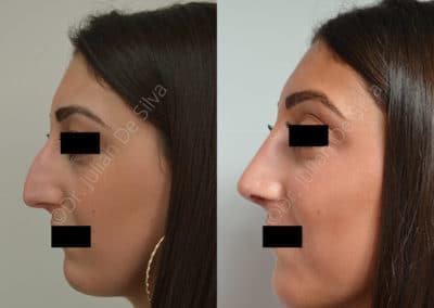 Rhinoplasty in London Before & After Results