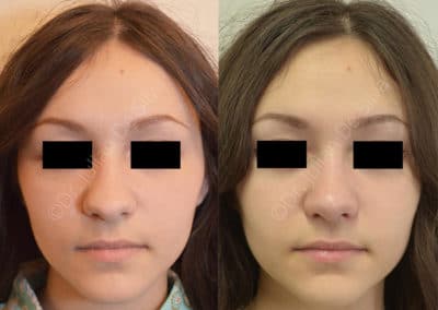 revision rhinoplasty london