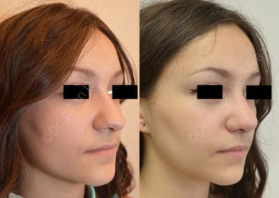 Rhinoplasty in London Before & After Results