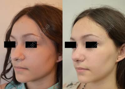 Rhinoplasty in London Before & After Results