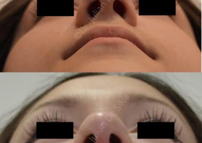 Rhinoplasty in London Before & After Results