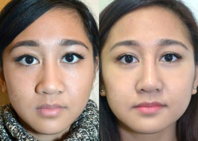 Rhinoplasty in London Before & After Results