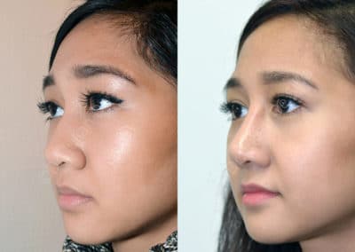 Rhinoplasty in London Before & After Results