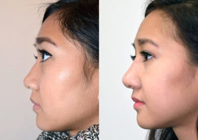 Rhinoplasty in London Before & After Results