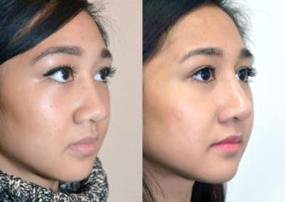 Rhinoplasty in London Before & After Results