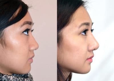 Rhinoplasty in London Before & After Results