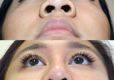 Rhinoplasty in London Before & After Results