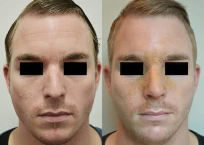 Rhinoplasty in London Before & After Results