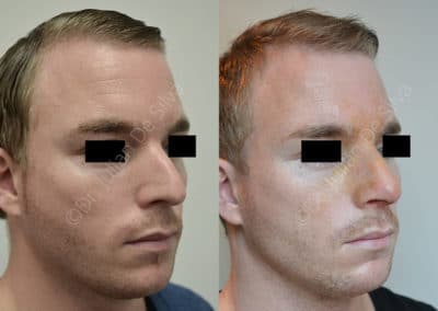 Rhinoplasty in London Before & After Results