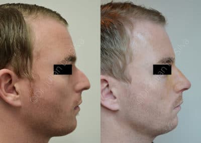 Rhinoplasty in London Before & After Results