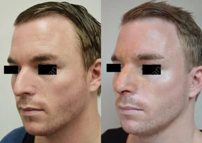 Rhinoplasty in London Before & After Results