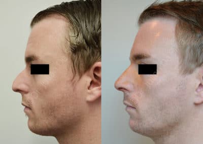 Rhinoplasty in London Before & After Results