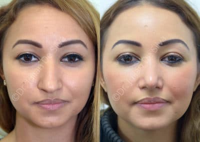 Rhinoplasty in London Before & After Results