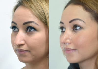 Rhinoplasty in London Before & After Results