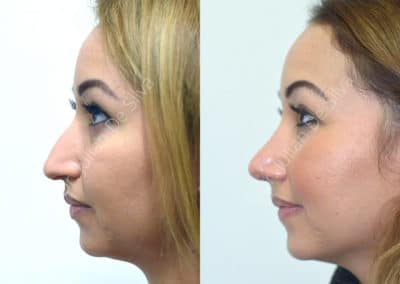 Rhinoplasty in London Before & After Results