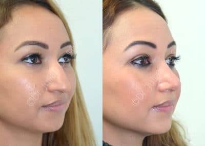 Rhinoplasty in London Before & After Results