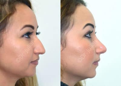 Rhinoplasty in London Before & After Results