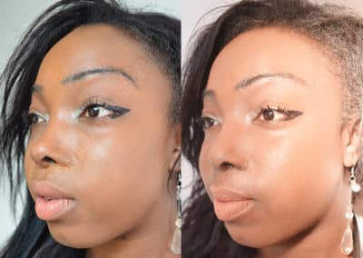 Rhinoplasty in London Before & After Results