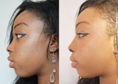 Rhinoplasty in London Before & After Results