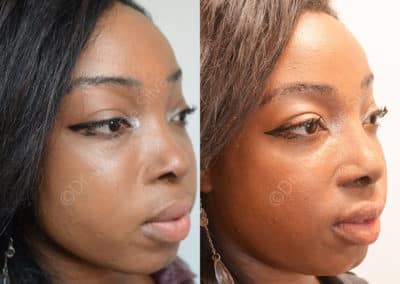 Rhinoplasty in London Before & After Results