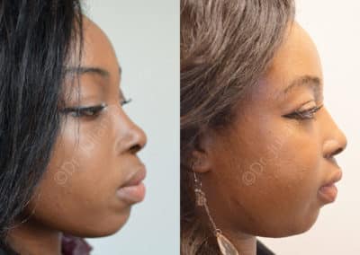 Rhinoplasty in London Before & After Results