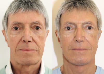 Facelift in London Before & After Results