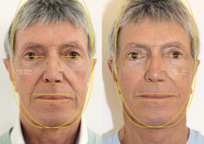 Facelift in London Before & After Results