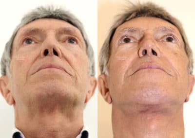 Facelift in London Before & After Results