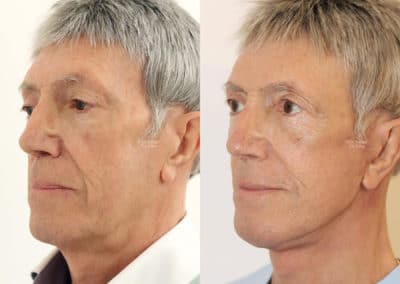 Facelift in London Before & After Results