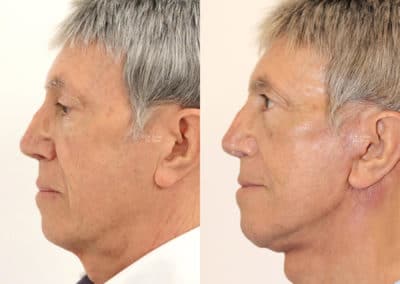 Facelift in London Before & After Results