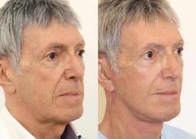 Facelift in London Before & After Results